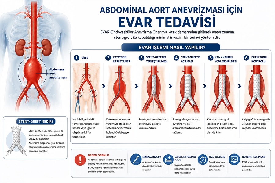 EVAR Nasıl Yapılır?