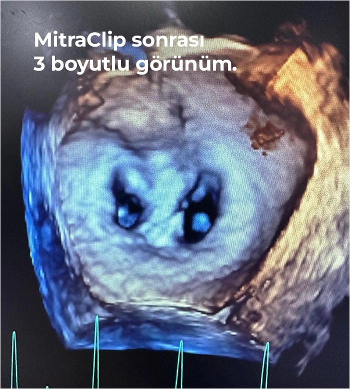 MitraClip sonrası 3 boyutlu görünüm