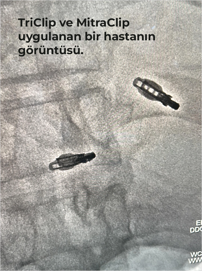 TriClip ve MitraClip uygulanan bir hastanın görüntüsü