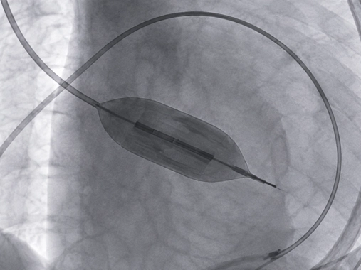 Mitral Kapak Darlığı Tedavisi