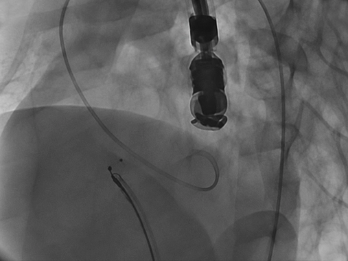 Ventriküler Septal Defekt (VSD)