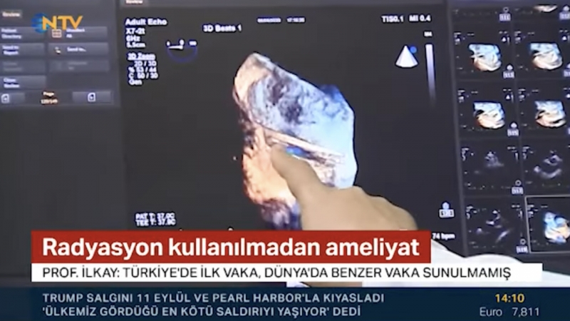 Radyasyon Kullanılmadan Ameliyat