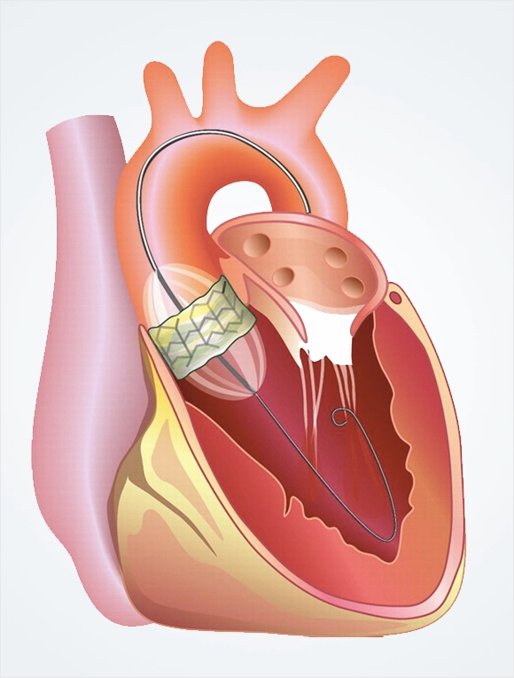TAVI 2